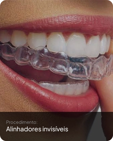 Alinhadores invisíveis aplicados na Idens Odontologia