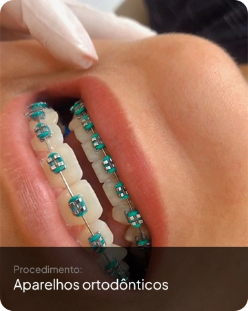 Aplicação de aparelho ortodôntico em paciente na Idens Odontologia