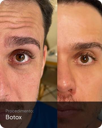 Resultado do botox aplicado em paciente na Idens Odontologia