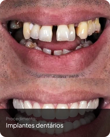 Resultado após a aplicação do implante dental feito na Idens Odontologia